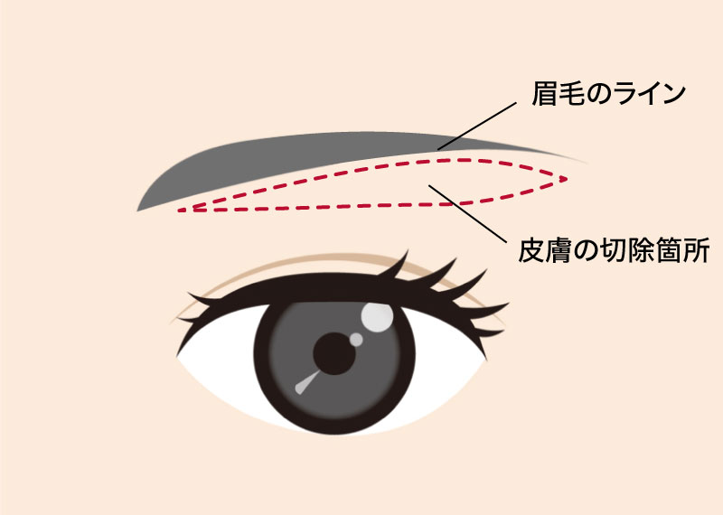 眉下切開手術で眉毛の直下を切開する施術