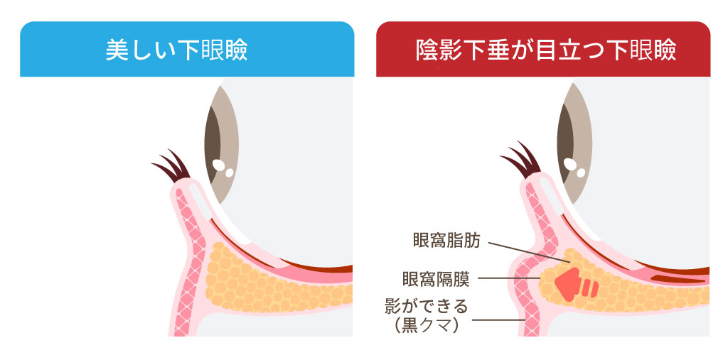 男性の目の下にクマができる原因