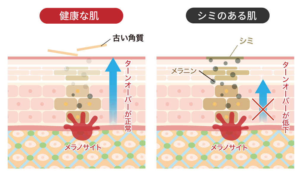 シミができる原因